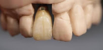 Nha khoa Minh Thu - nắn chỉnh răng và cấy ghép implant