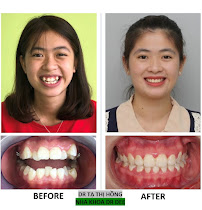 Nha Khoa DR DEE 450 Minh Khai -Hai Bà Trưng- Địa chỉ niềng răng - trồng răng Implant uy tín