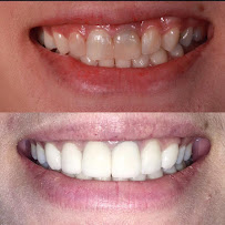 Deezy dental home บางรัก | ทำฟัน จัดฟัน วีเนียร์ รากฟันเทียม