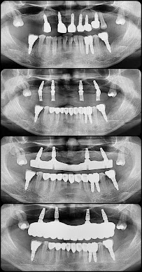 บางเเก้วสไมล์ คลินิกทันตกรรม bangkaew smile รักษาราก ทำรากเทียม ครอบฟัน วีเนียร์ Bangkaew Smile Dental Clinic