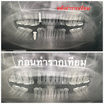 บางเเก้วสไมล์ คลินิกทันตกรรม bangkaew smile รักษาราก ทำรากเทียม ครอบฟัน วีเนียร์ Bangkaew Smile Dental Clinic