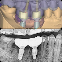 บางเเก้วสไมล์ คลินิกทันตกรรม bangkaew smile รักษาราก ทำรากเทียม ครอบฟัน วีเนียร์ Bangkaew Smile Dental Clinic
