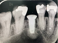 บางเเก้วสไมล์ คลินิกทันตกรรม bangkaew smile รักษาราก ทำรากเทียม ครอบฟัน วีเนียร์ Bangkaew Smile Dental Clinic