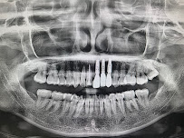 The Glass Smile Dental Clinic เดอะกลาสสไมล์ รากเทียม วีเนียร์ รักษาราก ครอบฟัน