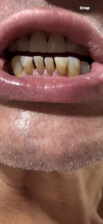 Dental İmplants Turkey İstanbul Clinic