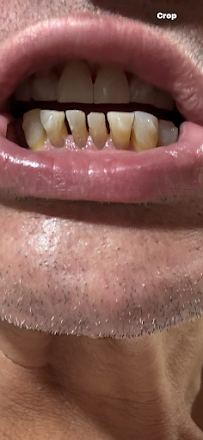Dental İmplants Turkey İstanbul Clinic