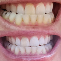The Teeth Whitener Bali