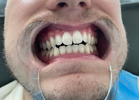 Bali Smile Teeth Whitening Seminyak