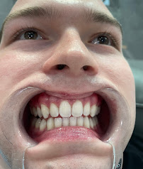 Bali Smile Teeth Whitening Seminyak