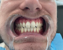Bali Smile Teeth Whitening Seminyak