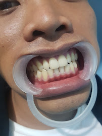 TUKANG GIGI PUSAT DENTAL BALI