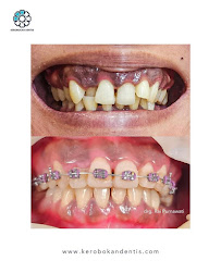 Kerobokan Dentis
