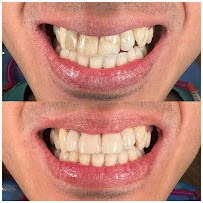 Drg.Herman Jaya Atmaja, Sp.Pros | Fullmouth Rehabilitation | Veneer and Dental Esthetic | Dental Implant