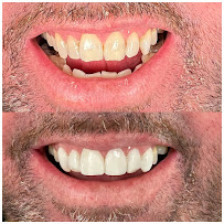 Drg.Herman Jaya Atmaja, Sp.Pros | Fullmouth Rehabilitation | Veneer and Dental Esthetic | Dental Implant