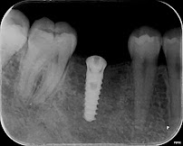 Drg.Herman Jaya Atmaja, Sp.Pros | Fullmouth Rehabilitation | Veneer and Dental Esthetic | Dental Implant