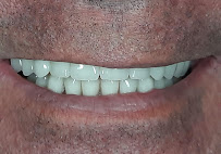 Drg.Herman Jaya Atmaja, Sp.Pros | Fullmouth Rehabilitation | Veneer and Dental Esthetic | Dental Implant