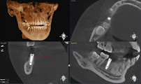 Drg.Herman Jaya Atmaja, Sp.Pros | Fullmouth Rehabilitation | Veneer and Dental Esthetic | Dental Implant