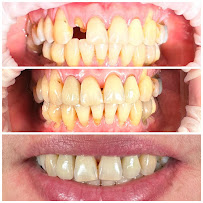 Drg.Herman Jaya Atmaja, Sp.Pros | Fullmouth Rehabilitation | Veneer and Dental Esthetic | Dental Implant
