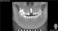 Drg.Herman Jaya Atmaja, Sp.Pros | Fullmouth Rehabilitation | Veneer and Dental Esthetic | Dental Implant