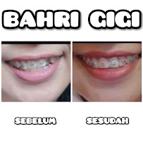 PASANG GIGI TERDEKAT BAHRI GIGI BATUBULAN