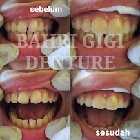 PASANG GIGI TERDEKAT BAHRI GIGI BATUBULAN