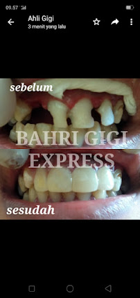PASANG GIGI TERDEKAT BAHRI GIGI BATUBULAN