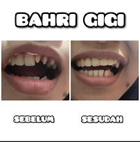 PASANG GIGI TERDEKAT BAHRI GIGI BATUBULAN