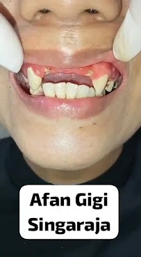 AHLI TUKANG GIGI SINGARAJA BALI