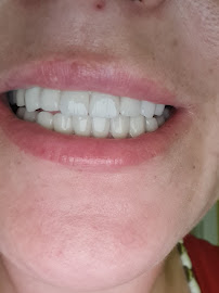 ÖZEL WESTDENT AĞIZ DİŞ HASTANESİ- Türkiye İzmir İmplant Diş Dent Clinic Türkey Dental İmplants in Turkey Zirconium in Turkey