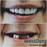ÖZEL WESTDENT AĞIZ DİŞ HASTANESİ- Türkiye İzmir İmplant Diş Dent Clinic Türkey Dental İmplants in Turkey Zirconium in Turkey