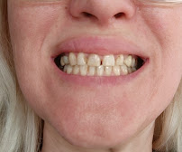 ÖZEL WESTDENT AĞIZ DİŞ HASTANESİ- Türkiye İzmir İmplant Diş Dent Clinic Türkey Dental İmplants in Turkey Zirconium in Turkey