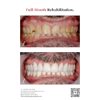 Fidelity Dental Implant & Full Mouth Rehab Bali