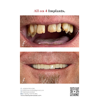 Fidelity Dental Implant & Full Mouth Rehab Bali