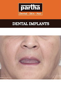 Partha Dental Clinic | Thiruvanmiyur, Chennai | Invisalign Provider | Braces, Root Canal & Dental Implants