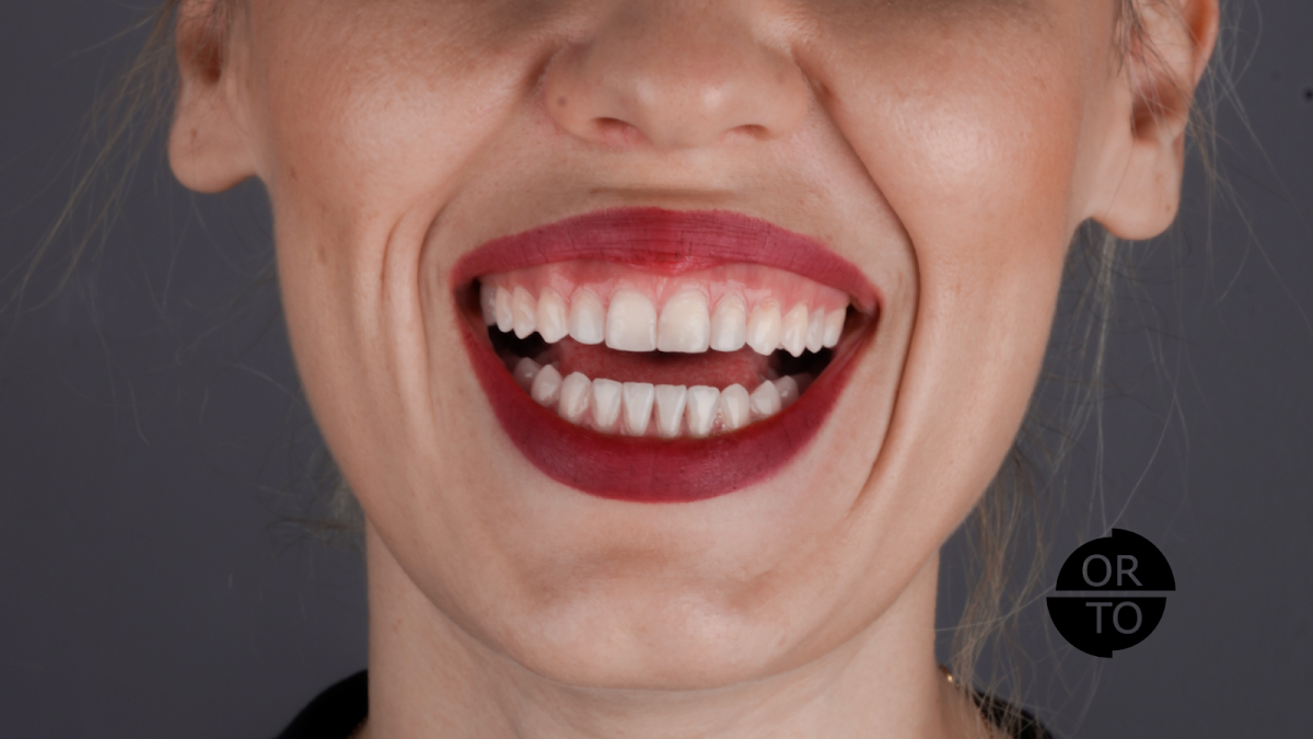 Ortodonti Uzman Dr Halil Toros Bingl Zmir effaf Plak Ortodontik Tedavi dental clinic