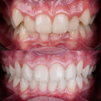 Ortodonti Uzmanı Dr. Halil Toros Bingöl - İzmir-Şeffaf Plak (invisalign) Ortodontik Tedavi