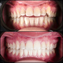 Ortodonti Uzmanı Dr. Halil Toros Bingöl - İzmir-Şeffaf Plak (invisalign) Ortodontik Tedavi