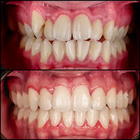 Ortodonti Uzmanı Dr. Halil Toros Bingöl - İzmir-Şeffaf Plak (invisalign) Ortodontik Tedavi