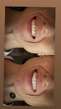 Ortodonti Uzmanı Dr. Halil Toros Bingöl - İzmir-Şeffaf Plak (invisalign) Ortodontik Tedavi
