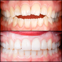 Ortodonti Uzmanı Dr. Halil Toros Bingöl - İzmir-Şeffaf Plak (invisalign) Ortodontik Tedavi