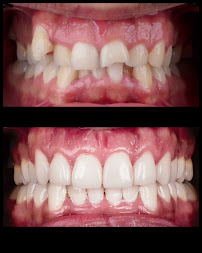 Ortodonti Uzmanı Dr. Halil Toros Bingöl - İzmir-Şeffaf Plak (invisalign) Ortodontik Tedavi
