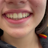 Ortodonti Uzmanı Dr. Halil Toros Bingöl - İzmir-Şeffaf Plak (invisalign) Ortodontik Tedavi