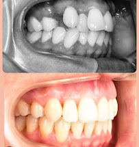 Doç.Dr.Halise Aydemir – İzmir Ortodonti Uzmanı (Folkart Towers)Ortognatik Cerrahi.Şeffaf plak(İnvisalign). Dijital Ortodonti