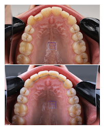 Ortodonti Uzmanı Çağrı Şibal - Ortodontik Tedavi I İzmir Şeffaf Plak I invisalign
