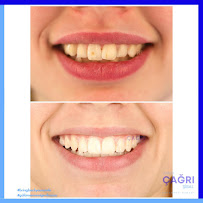 Ortodonti Uzmanı Çağrı Şibal - Ortodontik Tedavi I İzmir Şeffaf Plak I invisalign