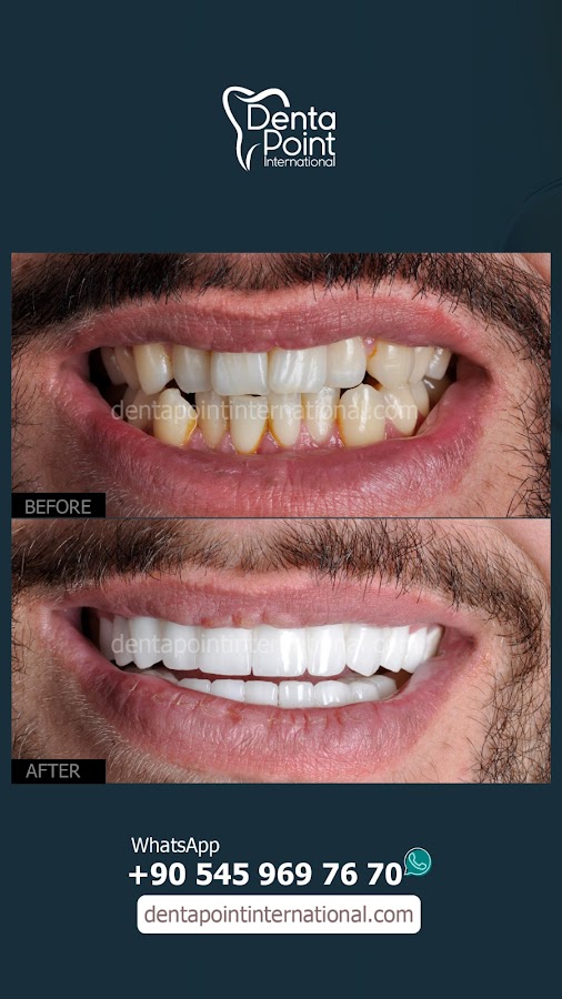 Zel Dentapoint Di Poliklinii Bostanl Ubesi Mplant Zirkonyum Estetik Di Acil Di Kanal Tedavisi dental clinic in Izmir