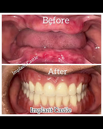 IMPLANT CASTLE — Dental Clinic |AIIMS Dentists | | Best Dental Clinic Perambur Chennai| RCT,Invisalign, Implant specialist