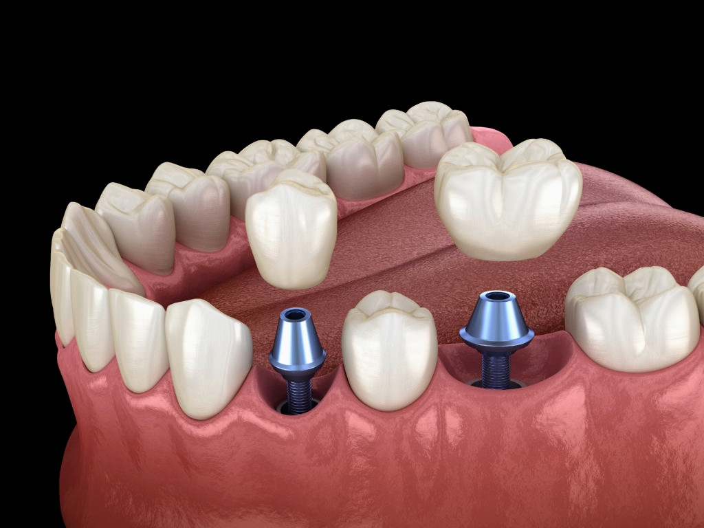 Smileasy Lasers and Implants Dental Clinic dental clinic