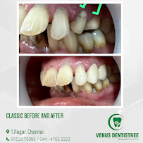 Venus Dentistree - Best Dental Aligners | Best Dental Implants