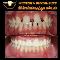 VIGNESH'S DENTAL ZONE (Advanced Implant, RCT, Braces, Pediatric, Invisalign & FMR Centre)